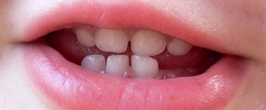 Baby Teething