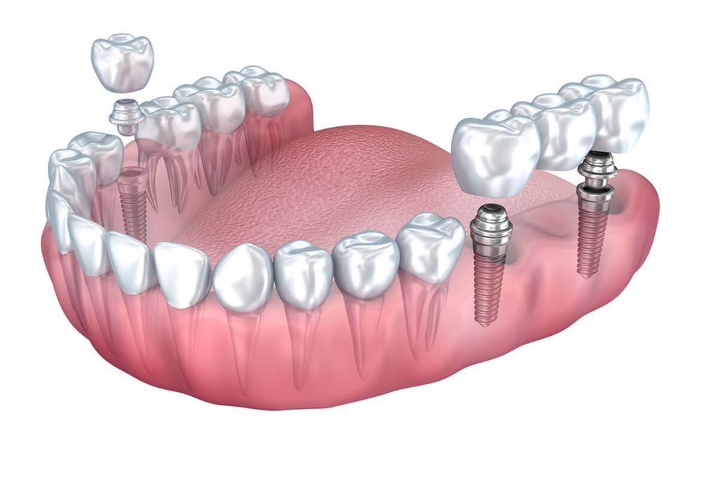 dental implants greenwood