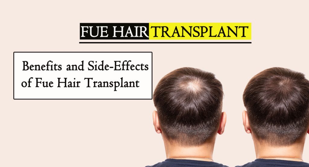 fue hair transplant- Benefits and Side-Effects of FUE Hair Transplant