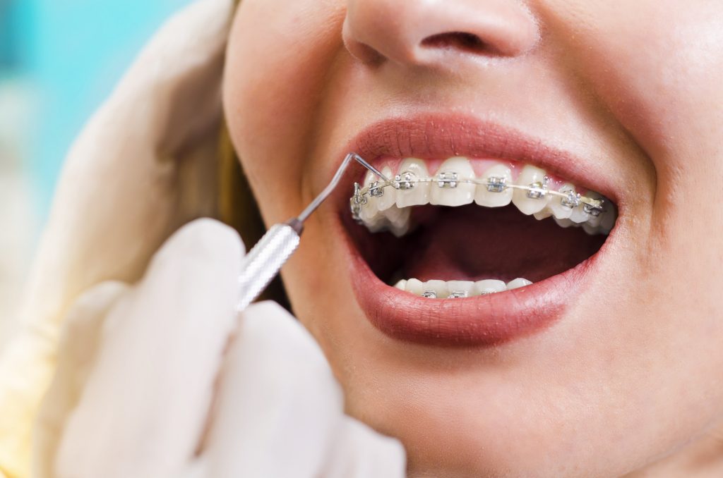 braces
