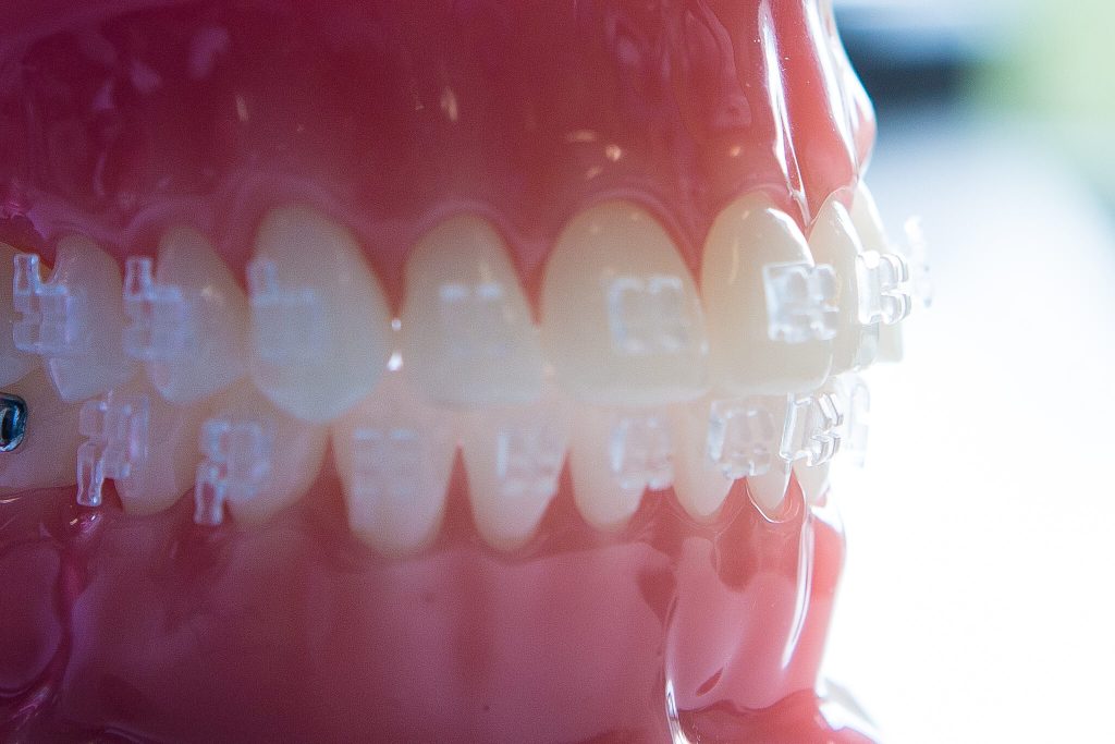 Clear Brace
